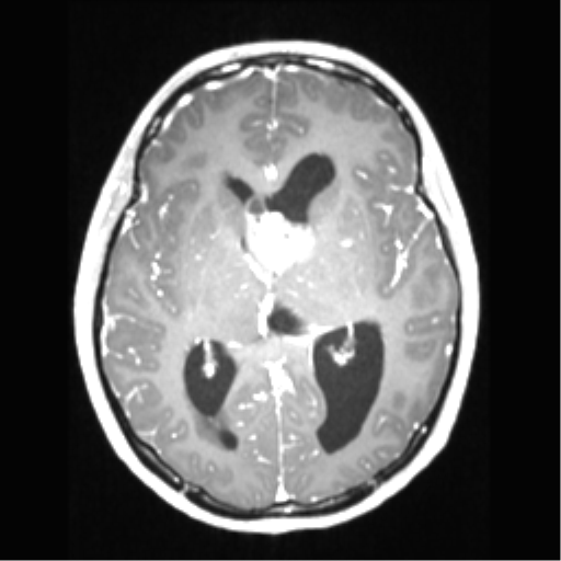 File:Central neurocytoma (Radiopaedia 37664-39557 Axial T1 C+ 41).png