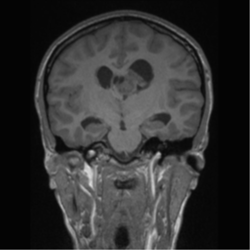 Central neurocytoma (Radiopaedia 37664-39557 Coronal T1 45).png