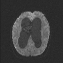 Central neurocytoma (Radiopaedia 56690-63469 Axial DWI 51).jpg