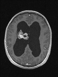Central neurocytoma (Radiopaedia 56690-63469 Axial T1 C+ 104).jpg