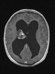 Central neurocytoma (Radiopaedia 56690-63469 Axial T1 C+ 96).jpg