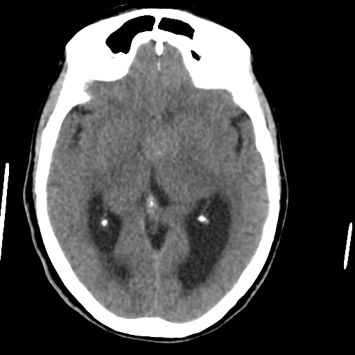 Central neurocytoma (Radiopaedia 65317-74346 Axial non-contrast 23).png