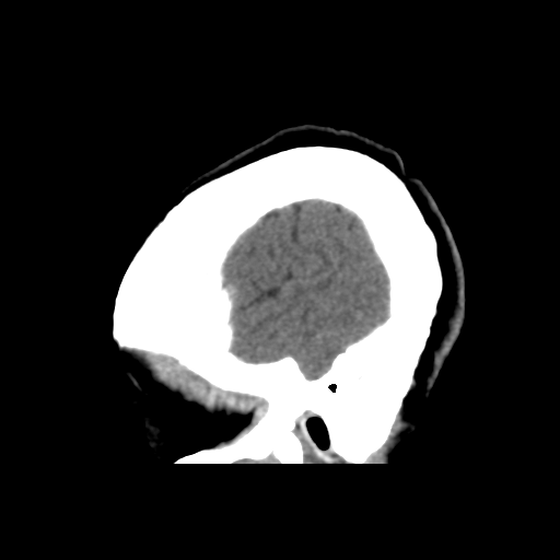 Central neurocytoma (Radiopaedia 65317-74346 C 9).png