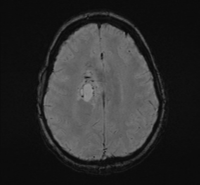 Central neurocytoma (Radiopaedia 70263-80336 Axial SWI 43).jpg