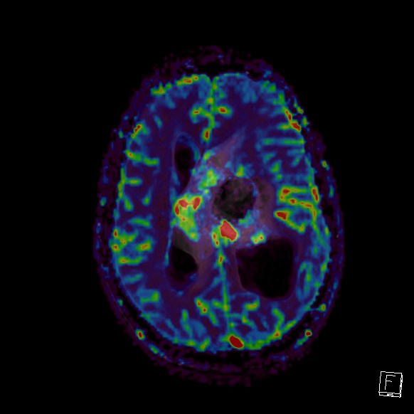 Central neurocytoma (Radiopaedia 84497-99872 Axial Perfusion 126).jpg