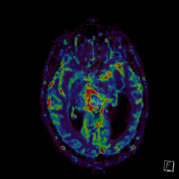 Central neurocytoma (Radiopaedia 84497-99872 Axial Perfusion 178).jpg