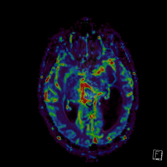 Central neurocytoma (Radiopaedia 84497-99872 Axial Perfusion 179).jpg