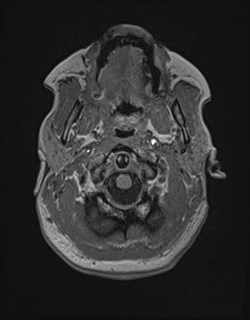 Central neurocytoma (Radiopaedia 84497-99872 Axial T1 25).jpg