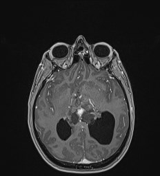 Central neurocytoma (Radiopaedia 84497-99872 Axial T1 C+ 79).jpg
