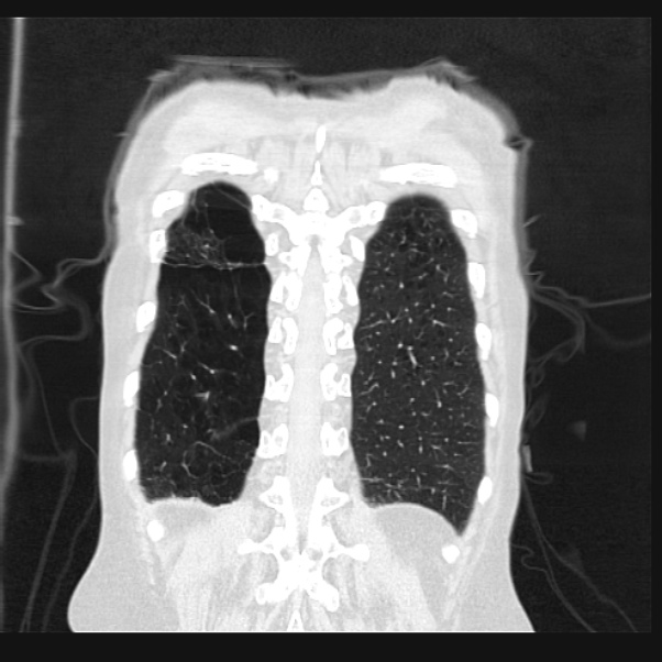 Centrilobular pulmonary emphysema (Radiopaedia 24495-24789 Coronal lung window 67).jpg