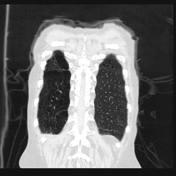 Centrilobular pulmonary emphysema (Radiopaedia 24495-24789 Coronal lung window 68).jpg
