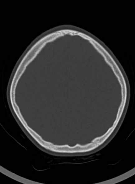 Cerebellar abscess (Radiopaedia 73727-84527 Axial bone window 52).jpg