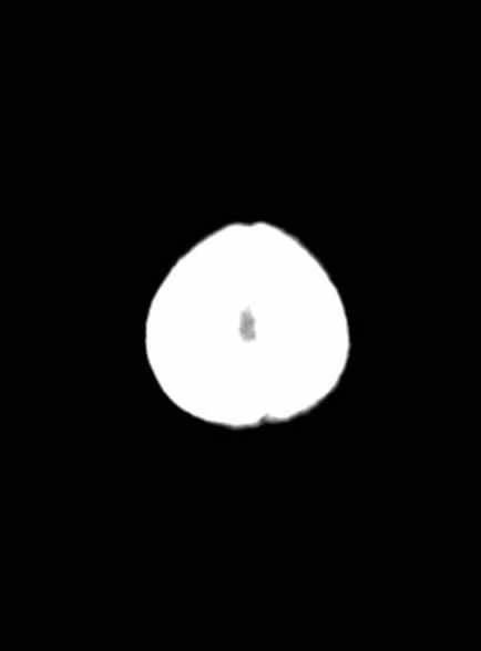 Cerebellar abscess (Radiopaedia 73727-84527 Axial non-contrast 63).jpg