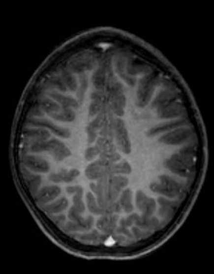 Cerebellar abscess (Radiopaedia 73727-84563 Axial T1 C+ fat sat 81).jpg