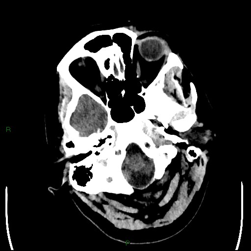 File:Cerebellar abscess (Radiopaedia 78135-90671 Axial non-contrast 16).jpg