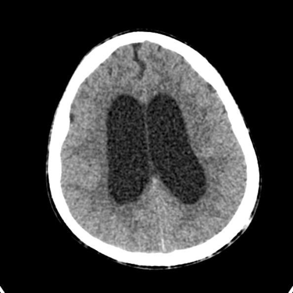 File:Cerebellar abscess secondary to mastoiditis (Radiopaedia 26284-26412 Axial non-contrast 107).jpg