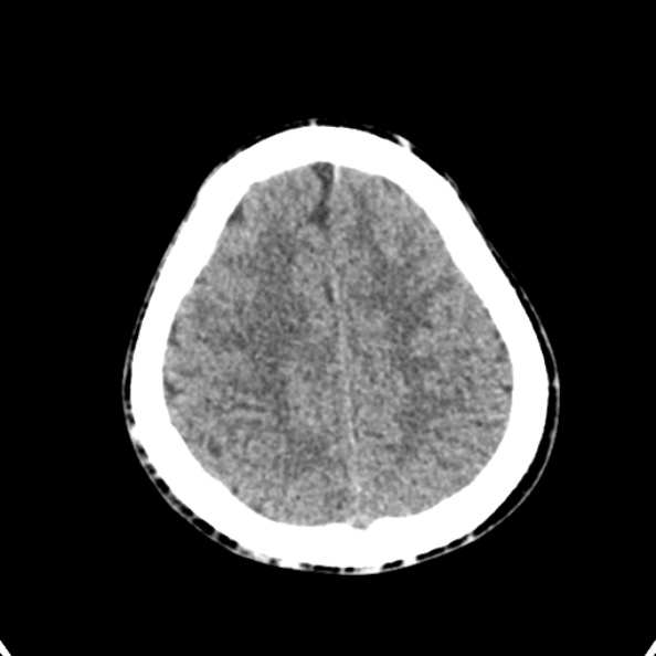 Cerebellar abscess secondary to mastoiditis (Radiopaedia 26284-26412 Axial non-contrast 130).jpg