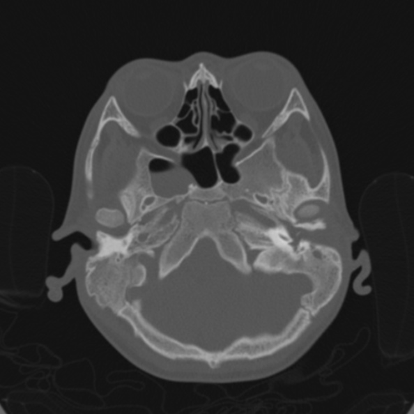File:Cerebellar abscess secondary to mastoiditis (Radiopaedia 26284-26413 Axial bone window 40).jpg