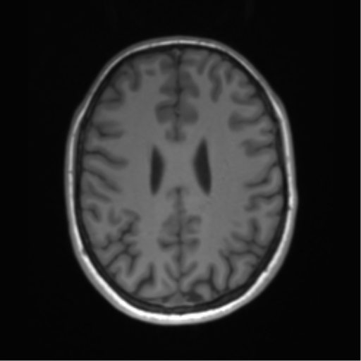 Cerebellar agenesis with hypoplastic pons (pontocerebellar hypoplasia) (Radiopaedia 57224-64138 Axial T1 52).png