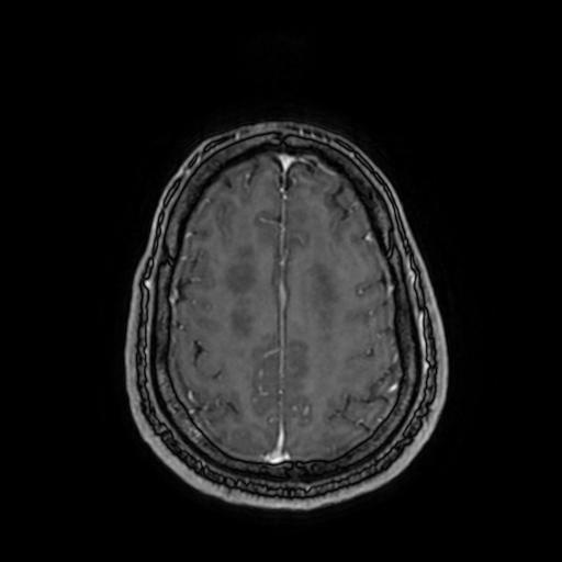 Cerebellar hemangioblastoma (Radiopaedia 88055-104622 Axial T1 C+ 137).jpg