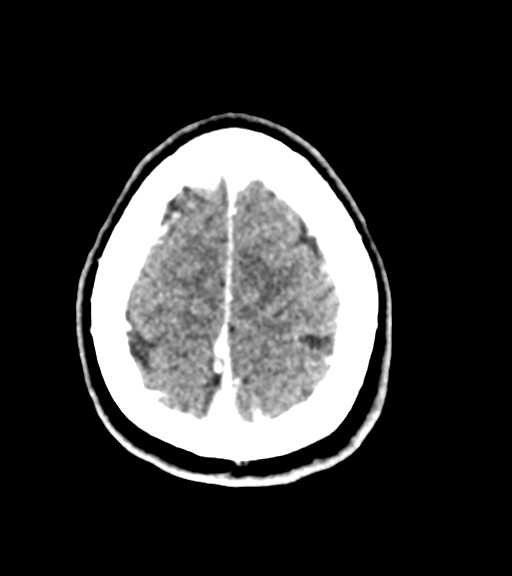 Cerebellar metastases - colorectal adenocarcinoma (Radiopaedia 40947-43652 Axial C+ 57).png