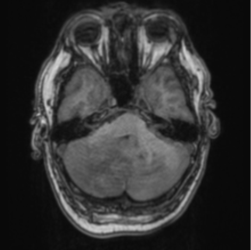 Cerebellar metastasis from lung adenocarcinoma (Radiopaedia 86690-102829 Axial T1 23).png