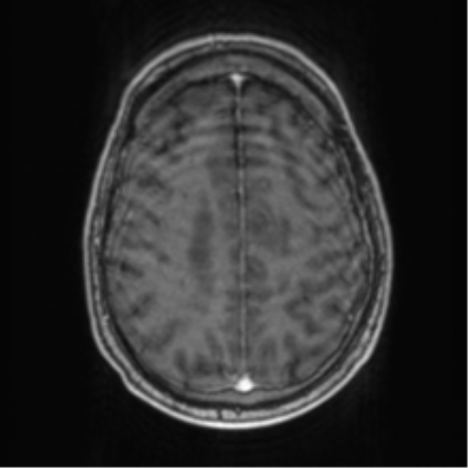 Cerebellar metastasis from lung adenocarcinoma (Radiopaedia 86690-102829 Axial T1 C+ 60).png