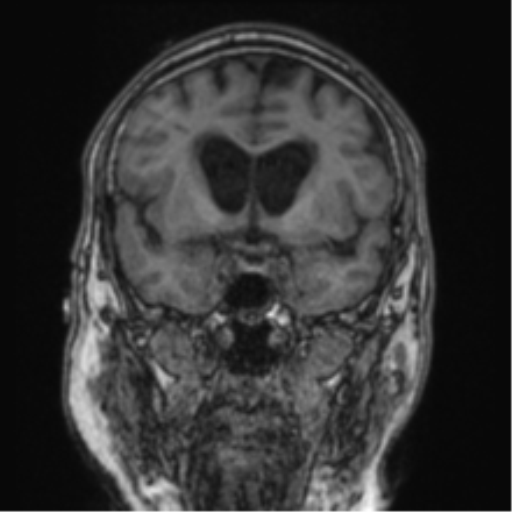 Cerebellar metastasis from lung adenocarcinoma (Radiopaedia 86690-102829 Coronal T1 63).png