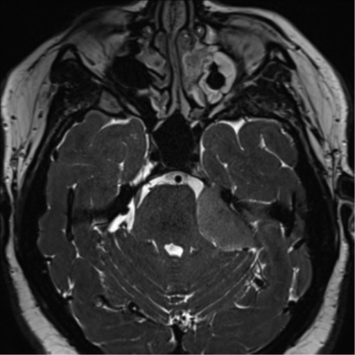 Cerebellopontine angle meningioma (Radiopaedia 48434-53348 Axial T2 Space 70).png