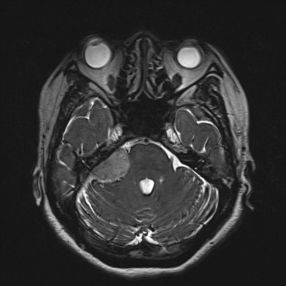 File:Cerebellopontine angle meningioma (Radiopaedia 53561-59591 Axial 3D volume T2 68).jpg