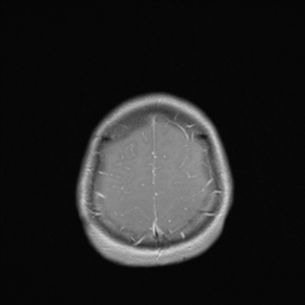 Cerebral abscess (Radiopaedia 24212-24478 Axial T1 C+ 51).jpg