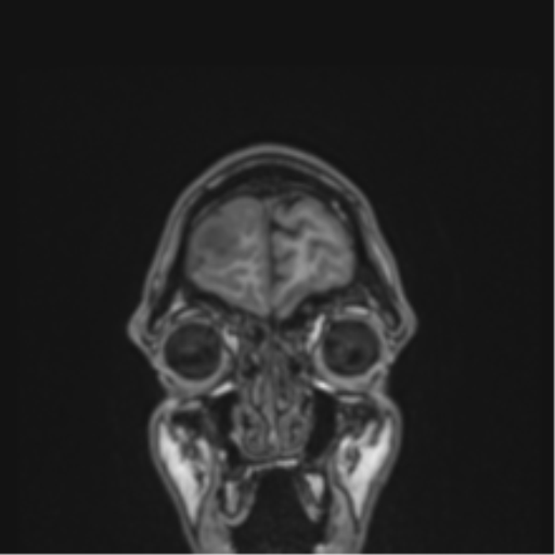 Cerebral abscess (Radiopaedia 60342-68009 Coronal T1 51).png