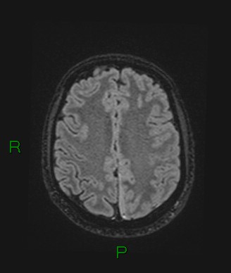 File:Cerebral abscess and subdural empyema (Radiopaedia 84436-99779 Axial FLAIR 28).jpg