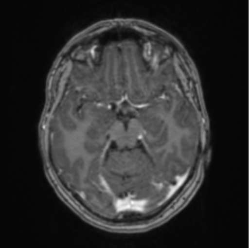 Cerebral abscess from pulmonary arteriovenous malformation (Radiopaedia 86275-102291 Axial T1 C+ 31).png