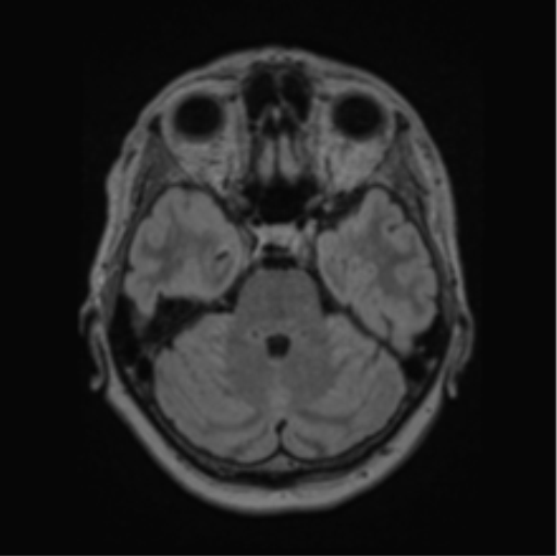 File:Cerebral abscess from pulmonary arteriovenous malformation (Radiopaedia 86275-102291 J 26).png