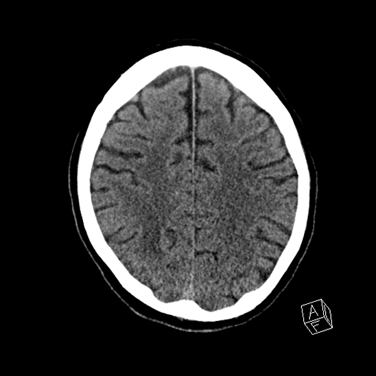 Cerebral abscess with ventriculitis (Radiopaedia 78965-91876 Axial non-contrast 35).jpg