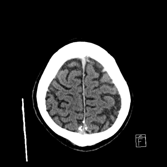 File:Cerebral abscess with ventriculitis (Radiopaedia 78965-91877 A 41).jpg