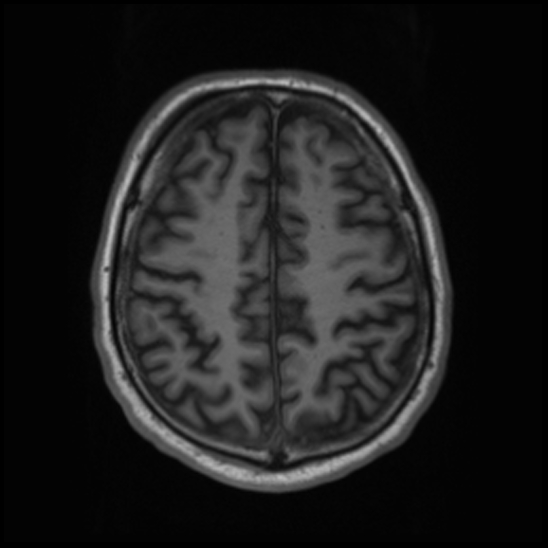 File:Cerebral abscess with ventriculitis (Radiopaedia 78965-91878 Axial T1 37).jpg
