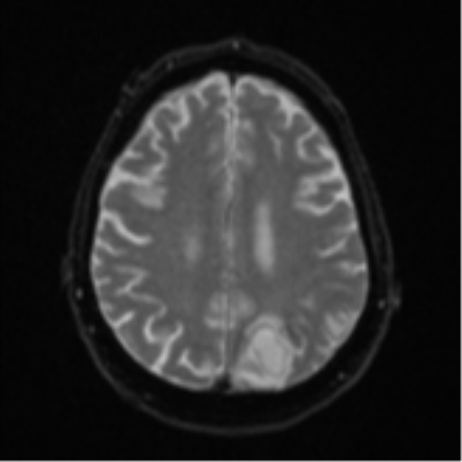 Cerebral abscesses- medically managed (Radiopaedia 45183-49179 Axial DWI 20).png