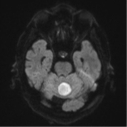Cerebral abscesses- medically managed (Radiopaedia 45183-49179 Axial DWI 38).png