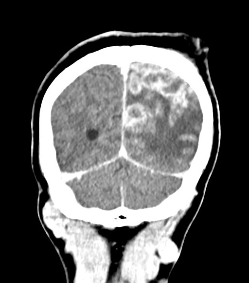Cerebral abscesses (Radiopaedia 70458-80568 Coronal Contrast 56).jpg