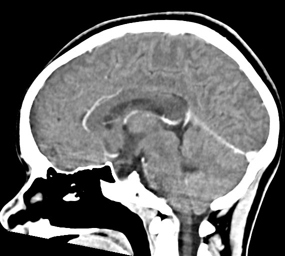 Cerebral abscesses (Radiopaedia 70458-80568 Sagittal Contrast 31).jpg