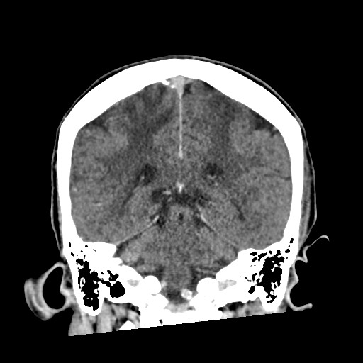 Cerebral amyloid angiopathy-related inflammation (Radiopaedia 74836-85848 Coronal non-contrast 46).jpg