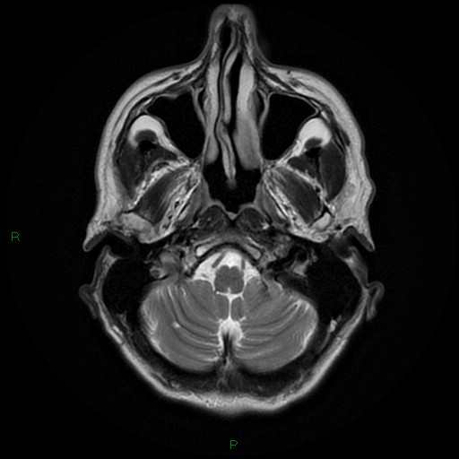 File:Cerebral amyloid angiopathy (Radiopaedia 77506-89664 Axial T2 5).jpg