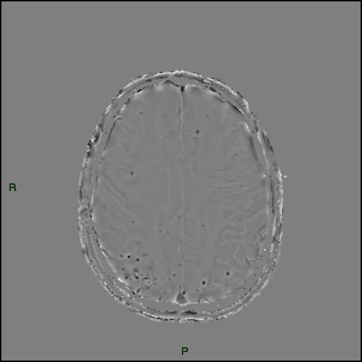 Cerebral amyloid angiopathy (Radiopaedia 77506-89664 H 73).jpg