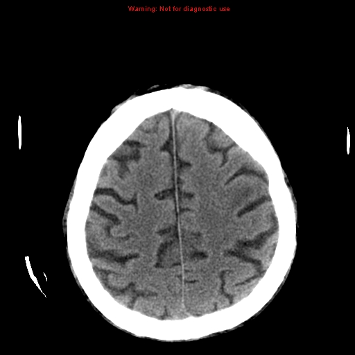 File:Cerebral and orbital tuberculomas (Radiopaedia 13308-13310 Axial non-contrast 22).jpg