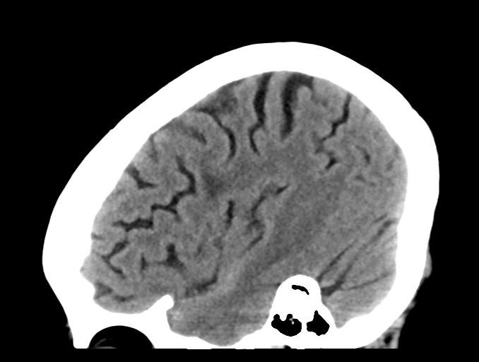 File:Cerebral aneurysm with rupture (Radiopaedia 29933-30457 B 8).jpg