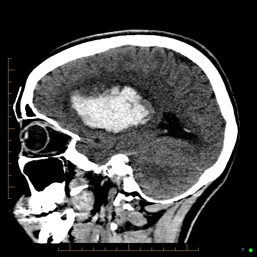 Cerebral arteriovenous malformation (AVM) (Radiopaedia 78162-90706 A 27).jpg