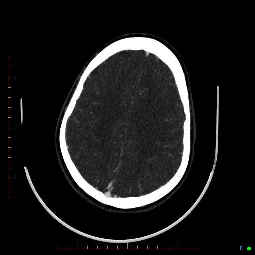 Cerebral arteriovenous malformation (AVM) (Radiopaedia 78162-90706 Axial CTA 203).jpg