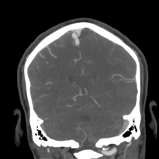Cerebral arteriovenous malformation (Radiopaedia 39259-41505 E 45).png